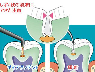 虫歯探知機（ダイヤグノデント）