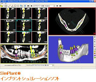 インプラント治療計画システム