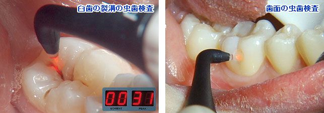 虫歯探知機（ダイヤグノデント）