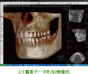 ＣＴ撮影データを３Ｄ映像化