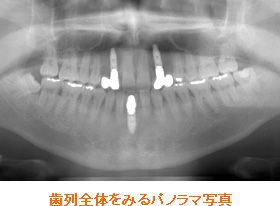 歯列全体をみるパノラマ写真