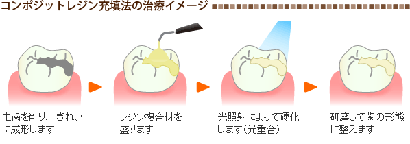 コンポジットレジン充填法の治療イメージ