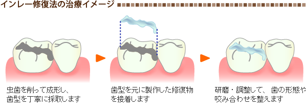 インレー修復法の治療イメージ