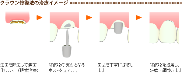 クラウン修復法