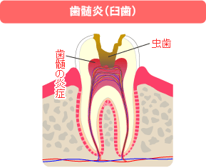 歯髄炎