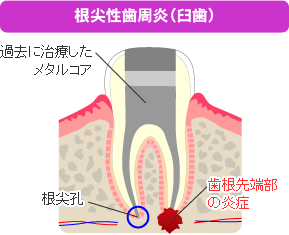 根尖性歯周炎