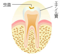 Ｃ１ ： エナメル質の虫歯