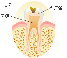 Ｃ２ ： 象牙質の虫歯