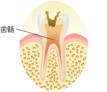 Ｃ３ ： 歯髄（歯の神経）の虫歯