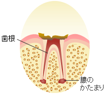 Ｃ４ ： 末期の虫歯