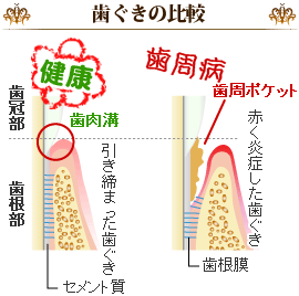 歯ぐきの比較