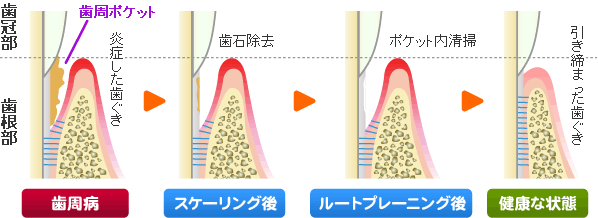 ルートプレーニング