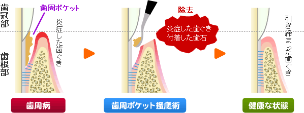 歯周ポケット掻爬（そうは）術