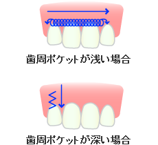 レーザーＳＲＰ