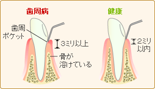 歯周ポケットの深度測定