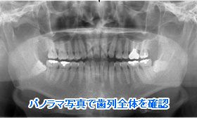 パノラマ写真で歯列全体を確認