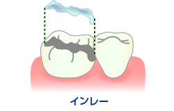 セラミックスインレー