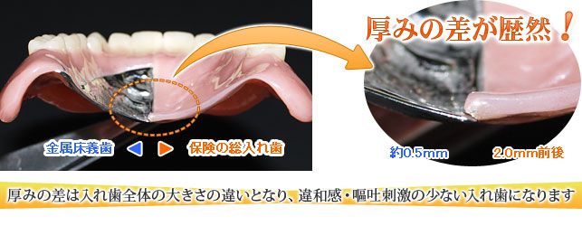 保険の入れ歯と金属床義歯の大きさの比較