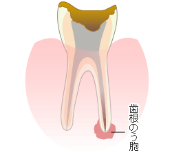 歯根のう胞摘出術