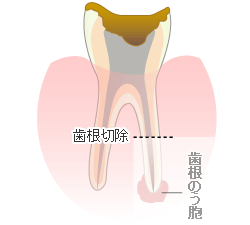 歯根端切除術