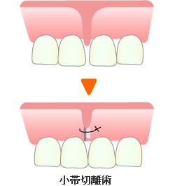 小帯切除術