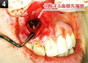 根尖病巣の除去と歯根端切除