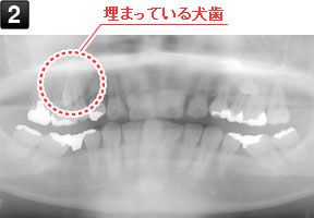 初診時パノラマ（レントゲン写真）