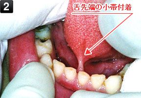 舌を上げた状態