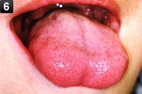 １週間後 舌を出した状態