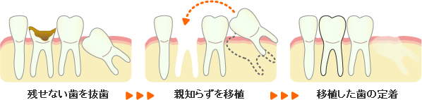 歯牙移植