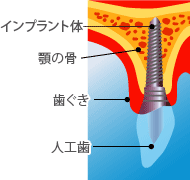 インプラント