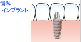 インプラント