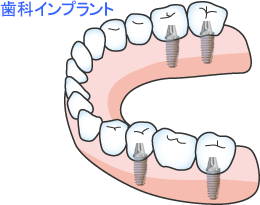 インプラント