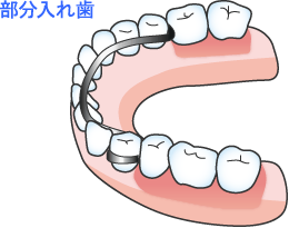 部分入れ歯