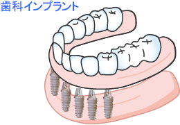 インプラント