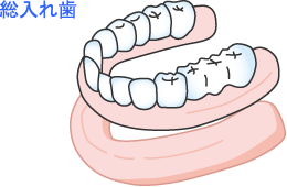 総入れ歯