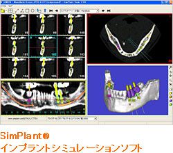 SimPlant(R) インプラントシミュレーションソフト