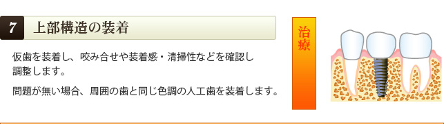 上部構造の装着