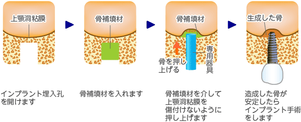 上顎洞底挙上術 － ソケットリフト（非開窓法）の手順