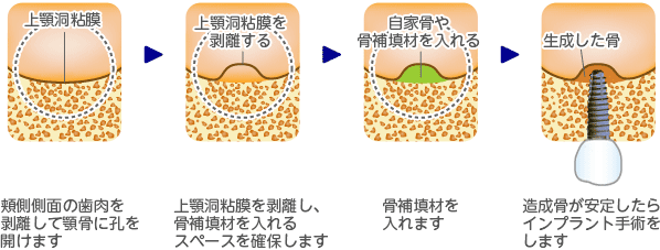 上顎洞底挙上術 － サイナスリフト（開窓法）の手順