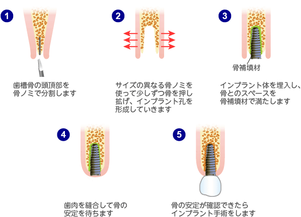 リッジエクスパンジョン法（スプリットクレスト法）