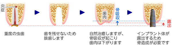 骨再生誘導法（GBR法）