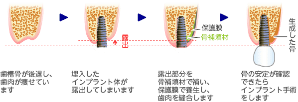 骨再生誘導法（GBR法）