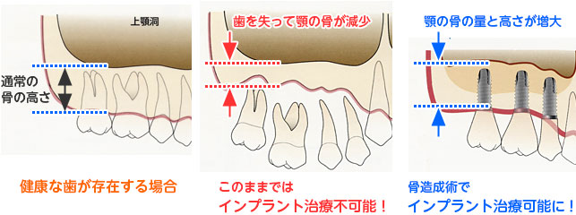 インプラントを可能にする骨造成術