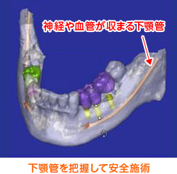 下顎管を把握して安全施術