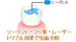 シーラント