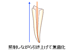 根管治療