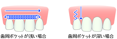 歯周レーザー治療