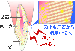 知覚過敏の改善