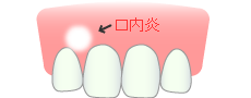 口内炎の改善